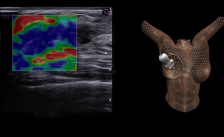ElaXto с BreastNav для компрессионной эластографии и оценки образований молочной железы 