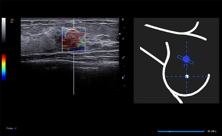 2D QElaXto с BreastNav для эластографии сдвиговой волны и оценки образований молочной железы