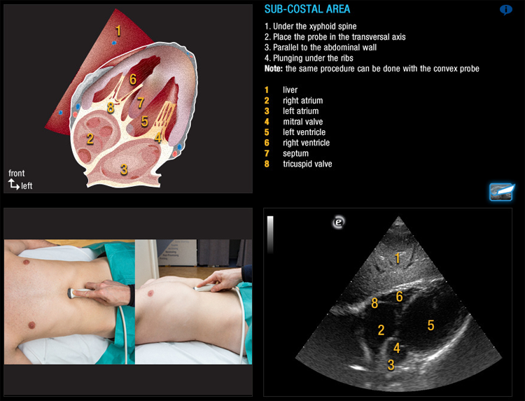 eFast protocol in trauma ultrasound