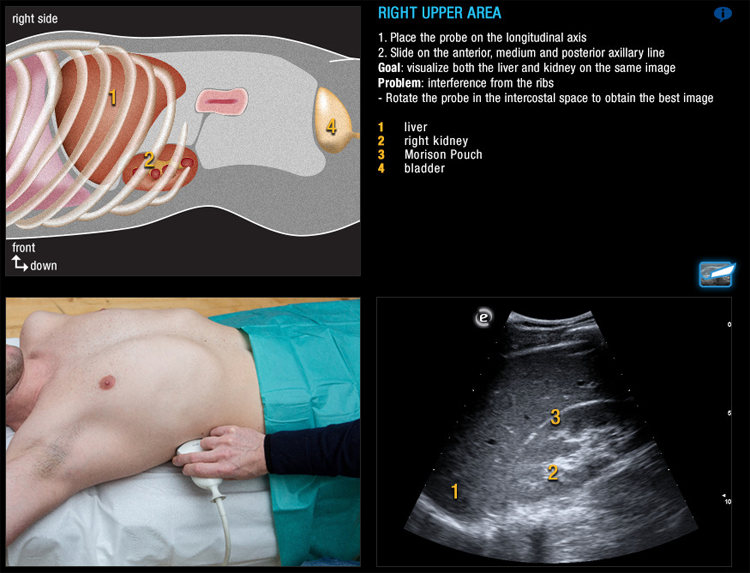 Ultrasound in Emergency Medicine – E-FAST procedure