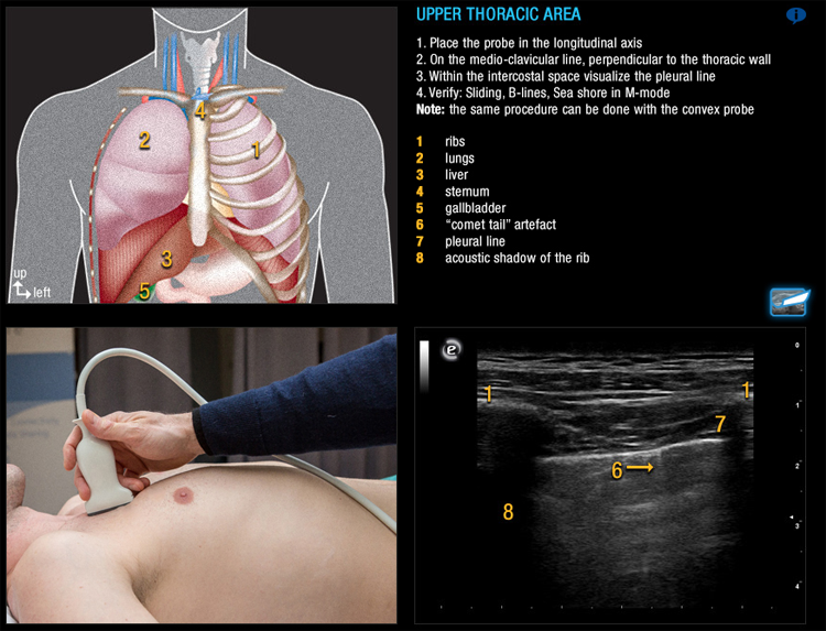 Ultrasound in Emergency Medicine – E-FAST procedure
