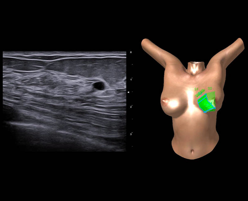 Visual feedback of the breast area covered by the probe with BreastNav technology