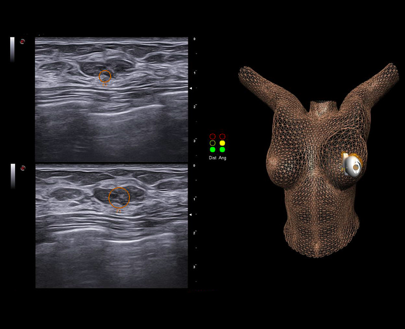 Breast lesion follow-up with BreastNav technology