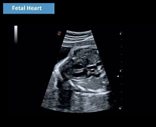 mylab omega fetal heart