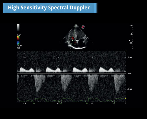 mylab omega spectral doppler