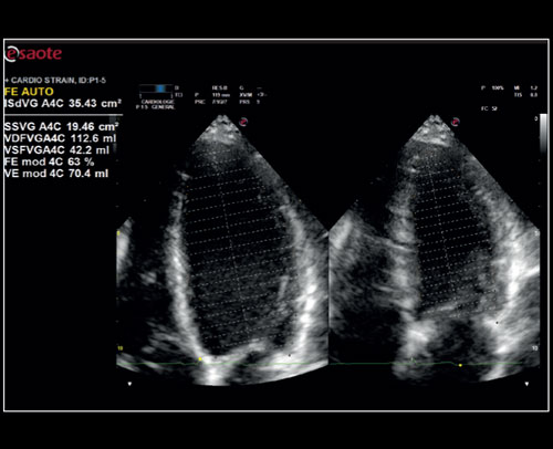 Cardiac - Zero-click EF measurement with Uterus - XLight 3D/4D exploration AutoEF