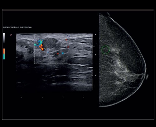 Breast - Accurate multimodality diagnosis with Follow Up and BodyMap