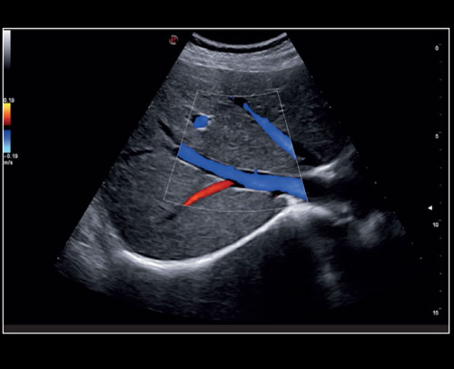 Liver - CPI with color Doppler