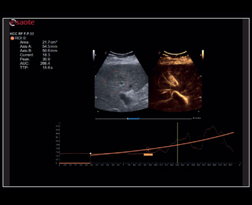 Liver - Contrast session with CnTI<sup>™</sup> and QPack