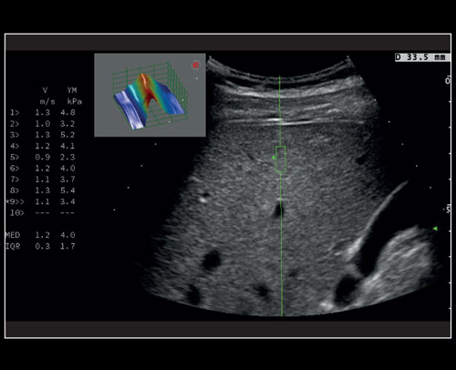 Liver - Stiffness quantification with QElaXto