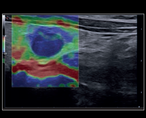 Thyroid - Lesion with ElaXto