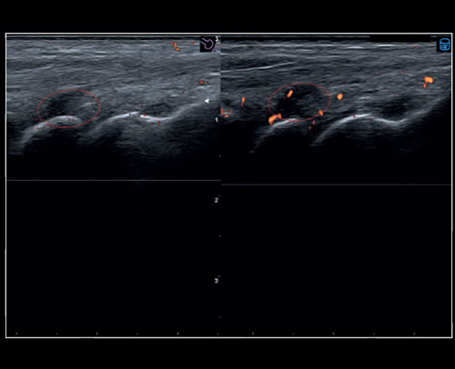 Musculoskeletal - Evolution of the inflammation with Follow Up and QPack