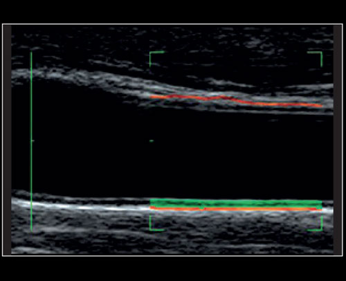 Carotid - Real-time measurement of the Intima Media with QIMT