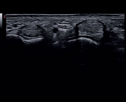 Superficial tendons - Very high frequency exploration of up to 24MHz