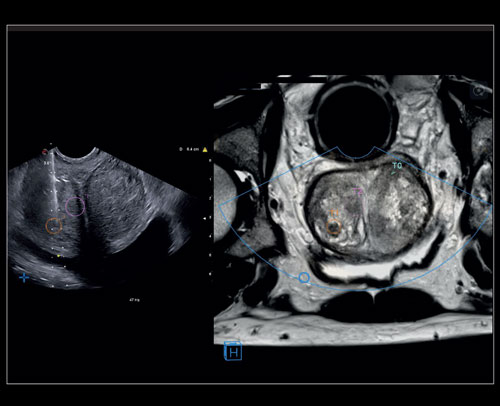 Urology - Prostate biopsy with Virtual Navigator fusion imaging 3D