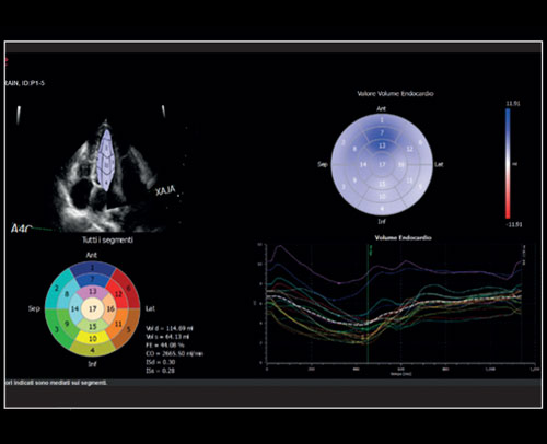 Left Ventricule - Volumetric model of the left function with XStrain4D