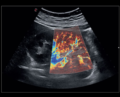 Kidney - Tissue perfusion visualisation with microV