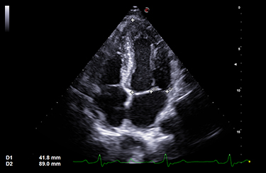 Ultrasound Solutions for Cardiac Applications