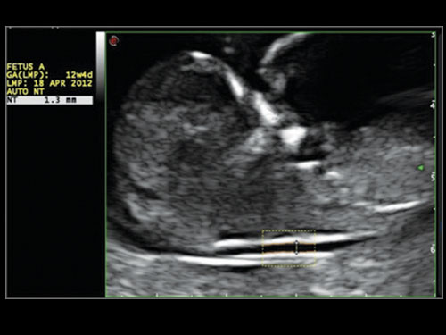 Thickness ultrasound nuchal Nuchal Translucency