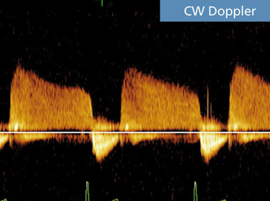 Клиническое изображение – MyLab<sup>™</sup>Seven – (CW Doppler)