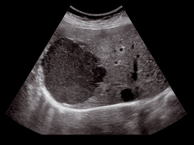 Clinical Image - MyLab<sup>™</sup>Seven - Liver Lesion (XView & MView Imaging)