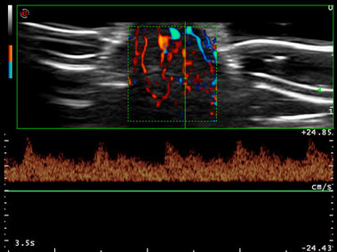 Clinical Image - MyLab<sup>™</sup>Seven - HD Power Doppler Imaging
