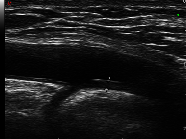 Clinical Image - MyLab<sup>™</sup>Twice - Axillary arteritis