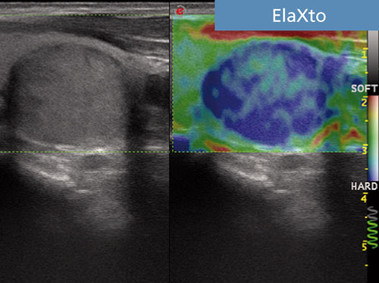 Clinical Image - MyLab<sup>™</sup>Seven - ElaXto Imaging