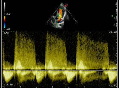 Klinische Bildgebung – MyLab<sup>™</sup>9 Platform – Erweiterte CW Doppler- Verarbeitungskette zur Messung der Aortenstenose