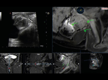 Clinical Image - MyLab<sup>™</sup>Twice - Real-time PET Navigation