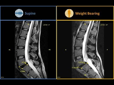 G-scan Brio - Anterolisthesis