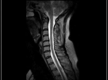 G-scan Brio - CSpine - FSE T2 Sagittal