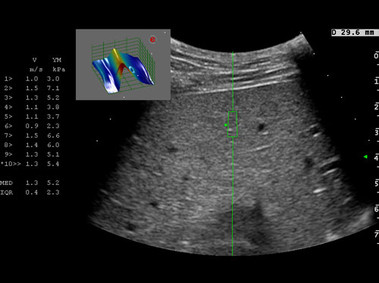Clinical Image - MyLab<sup>™</sup>Twice - Shearwave Elastography