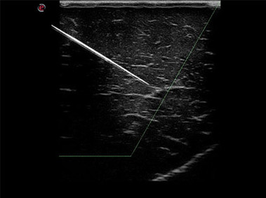 Clinical Image - MyLab<sup>™</sup>Seven - Needle enhancement