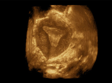 Clinical Image - MyLab<sup>™</sup>Eight Platform - 3D Imaging - Gynaecology