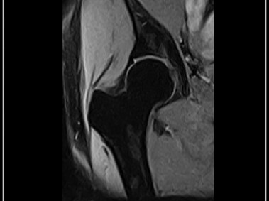 G-scan Brio - Hip - XBone Coronal