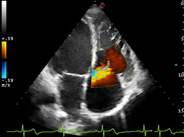 Clinical Image - MyLab<sup>™</sup>Eight Platform - Heart (4CH-Color)