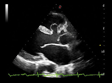 Clinical Image - MyLab<sup>™</sup>Alpha - Heart (XView & TEI<sup>™</sup>Imaging)