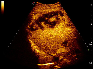Clinical Image - MyLab<sup>™</sup>Twice - Liver Lesion (CnTI<sup>™</sup> Imaging)