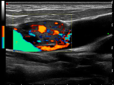 Clinical Image - MyLab<sup>™</sup>Alpha - HD Doppler Imaging