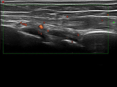 Clinical Image - MyLab<sup>™</sup>Twice - Hand (XFlow Imaging)