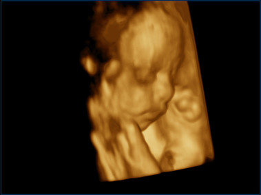 Clinical Image - MyLab<sup>™</sup>Twice - Baby Face (X4D Imaging)
