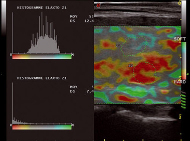 Clinical Image - MyLab<sup>™</sup>Twice - Breast (ElaXto Imaging)