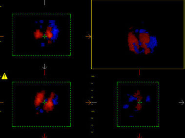 Clinical Image - MyLab<sup>™</sup>Eight Platform - 3D Imaging - Cardio (Stick)
