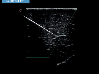 Klinisches Bild- MyLab<sup>™</sup>X5: Needle visibility