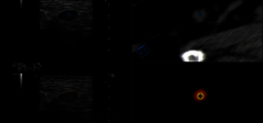 Clinical Image - MyLab™Eight eXP - Lesion detection in ginecology with multiparametric approach