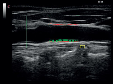 Immagine clinica - MyLab<sup>™</sup>Six - Arteria carotide (Imaging RFQIMT)