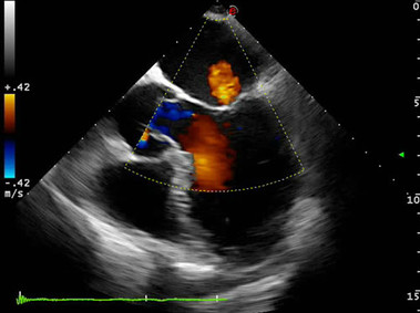Clinical Image - MyLab<sup>™</sup>Eight Platform - Heart (Color-TEE)