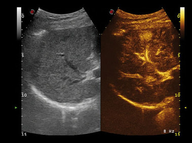 Clinical Image - MyLab<sup>™</sup>Alpha - Liver (CnTI<sup>™</sup>Imaging)