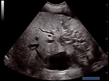Clinical Image - MyLab<sup>™</sup>Twice - Liver Lesion